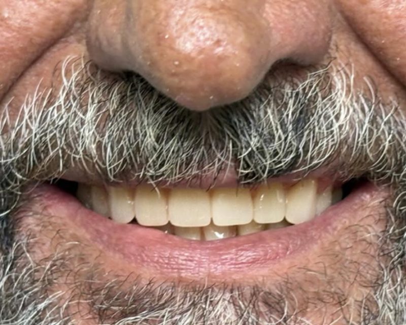 Depois da reabilitação oral