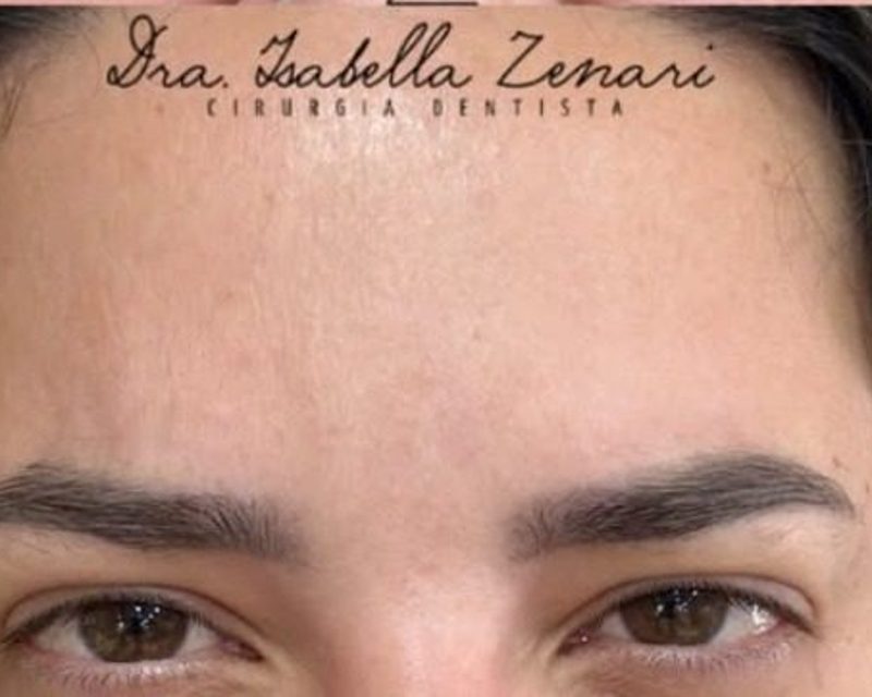 Depois da toxina botulínica